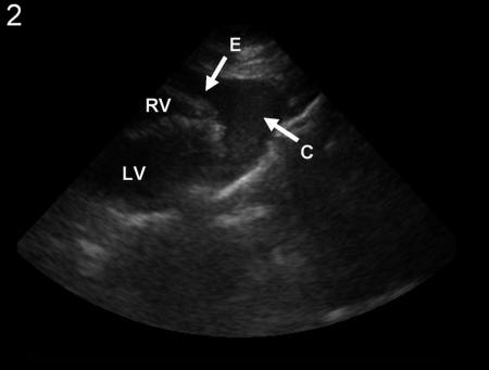 Adjuvant Role of CT in the Diagnosis of Post-Infarction Left ...