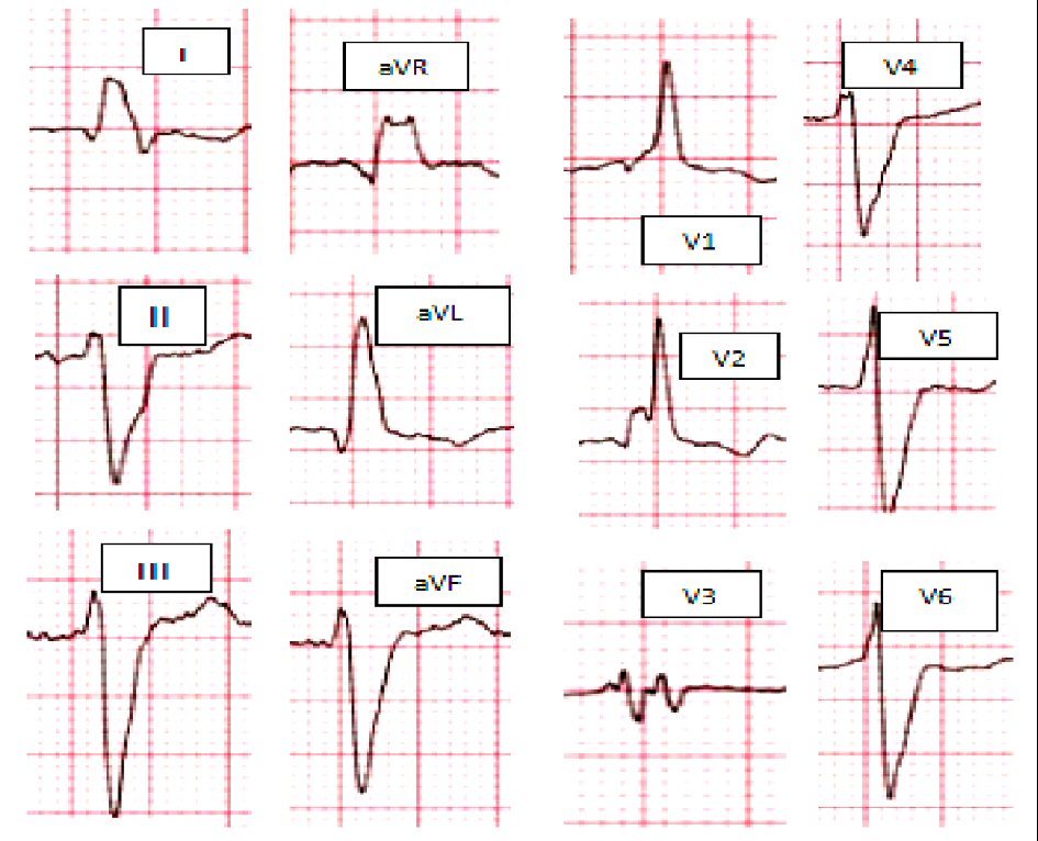 ivcd consider atypical rbbb
